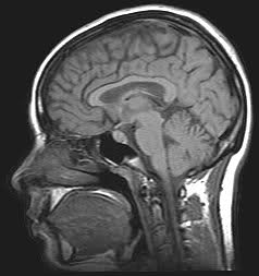 MRI scan of a human brain